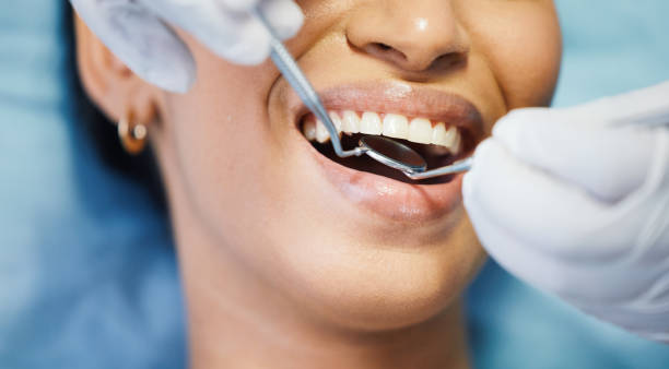 Best Emergency Dentist for Lost Fillings or Crowns in Springdale, NC